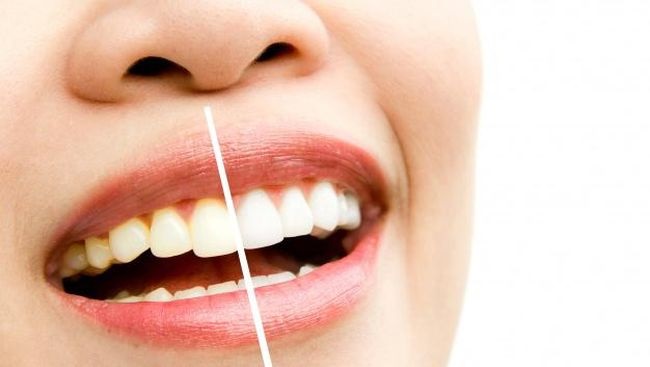 Cara Memutihkan Gigi Secara Alami Tanpa Perlu Dokter Gigi