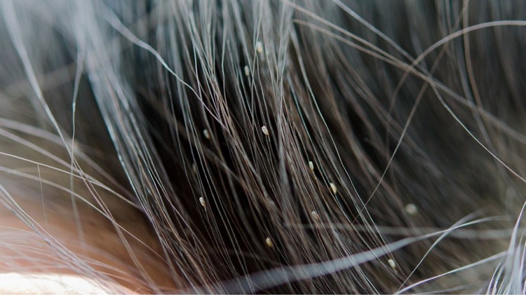 Cara Menghilangkan Kutu Rambut Yang Efektif